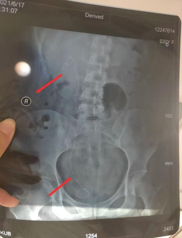 趣炒股 “左侧输尿管手术误做右侧，助手给主刀医生顶锅”？女患者获判赔5.4万，希望进一步追责